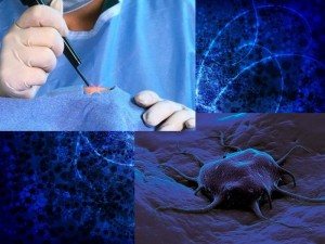 Опухоли, рак.